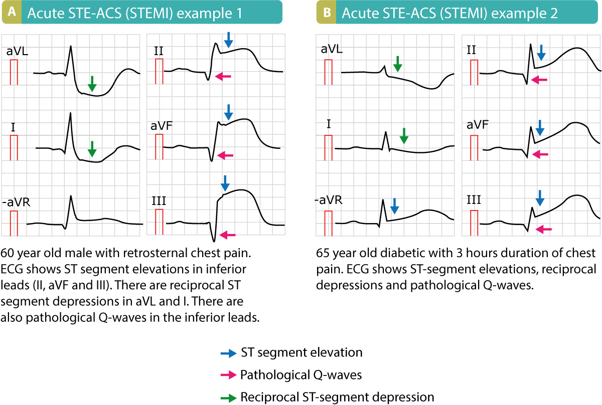 Figur 1. Eksempler på STE-ACS (STEMI). Bemærk, at disse patienter havde patologiske Q-bølger, hvilket betyder, at disse EKG'er blev optaget flere timer efter symptomdebut, eller at de er tegn på et gammelt infarkt.