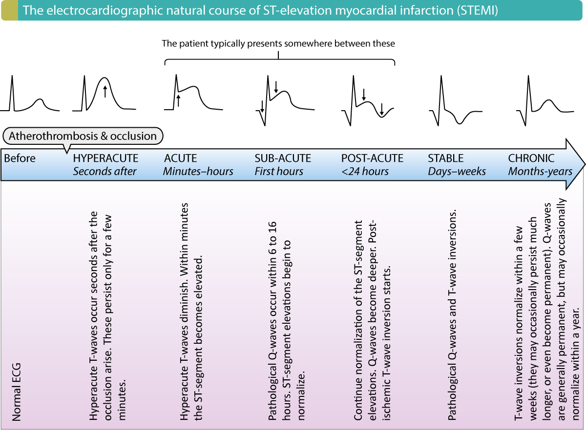 Figur 2. Det elektrokardiografiske naturlige forløb ved STEMI (ST-elevation myokardieinfarkt).