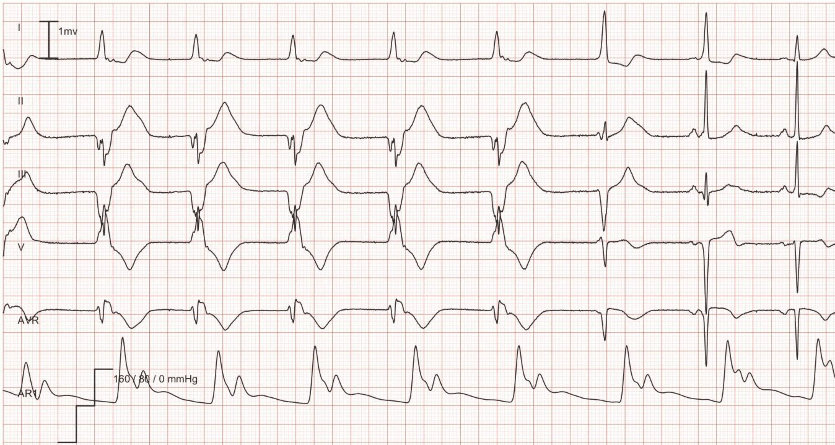 EKG-eksempel: Idioventrikulær rytme (accelereret ventrikulær rytme) - Accelereret ventrikulær rytme med en hastighed på 56 i de første 5 slag efterfulgt af 2 fusionsslag; de sidste 2 slag er normal sinusrytme.