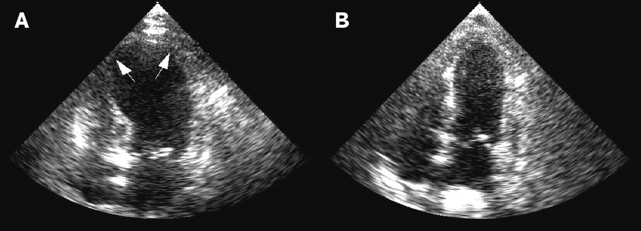 Figur 1. Ekkokardiogram, der viser takotsubo-kardiomyopati i den akutte fase (A) og opløsningsfasen (B). Bemærk den apikale ballooning af den apikale del af venstre ventrikel (A).