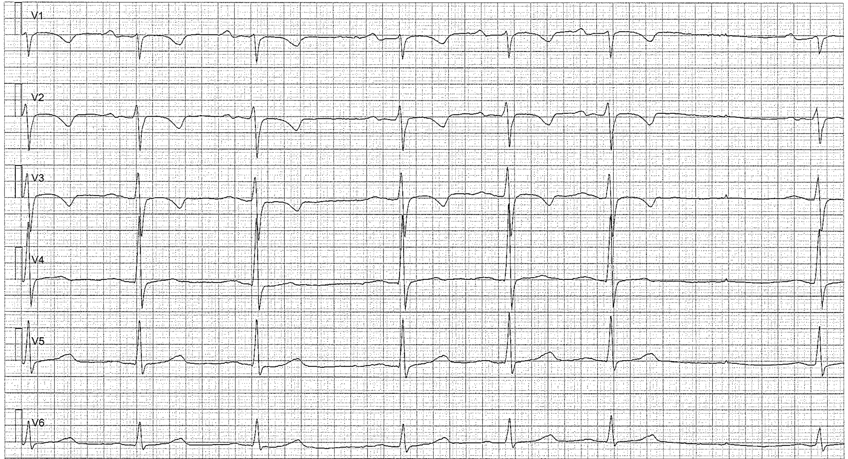 Figur 4. Sinusarytmi med sinuspaus. Negativa T-vågor är normalt i V1–V3 (patienten var 15 år gammal när EKG registrerades).