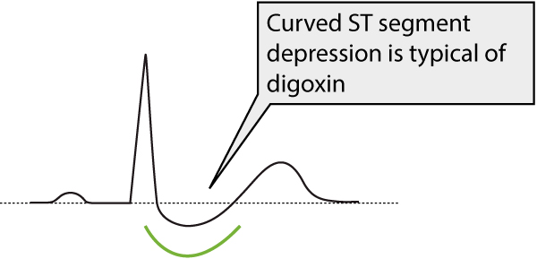 Figur 1. ST-segmentdepression på grund af digoxinbehandling.