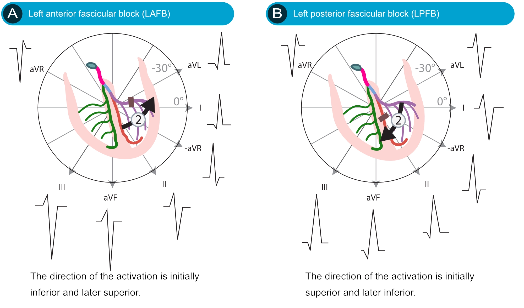 Venstre anterior fascikulær blok (anterior hemiblok) og venstre posterior fascikulær blok (posterior hemiblok).
