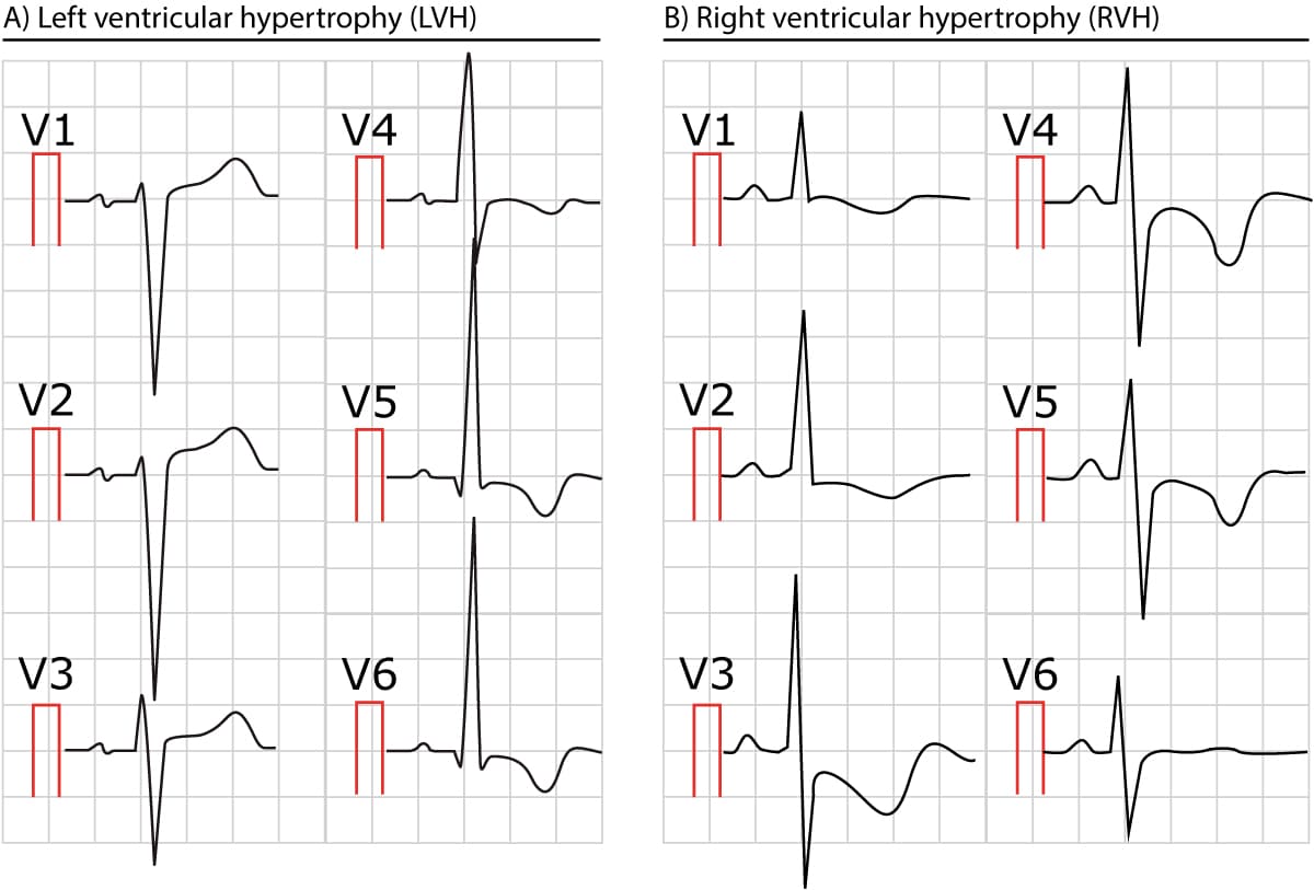 Figur 2. To EKG'er, der viser venstre og højre ventrikelhypertrofi.