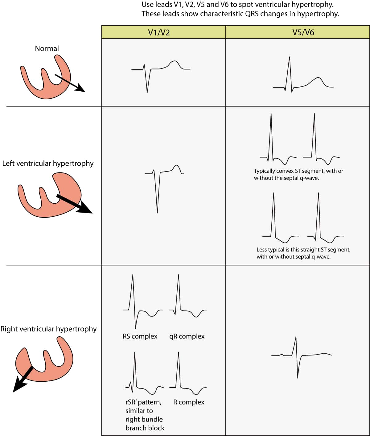 Figur 1. EKG-ændringer set ved venstre ventrikelhypertrofi (LVH) og højre ventrikelhypertrofi (RVH). Den elektriske vektor i venstre ventrikel er forstærket ved LVH, hvilket resulterer i store R-bølger i venstresidede afledninger (V5, V6, aVL og I) og dybe S-bølger i højresidede brystafledninger (V1, V2). Højre ventrikelhypertrofi forårsager store R-bølger i højresidede brystafledninger og dybere S-bølger i venstresidede afledninger.