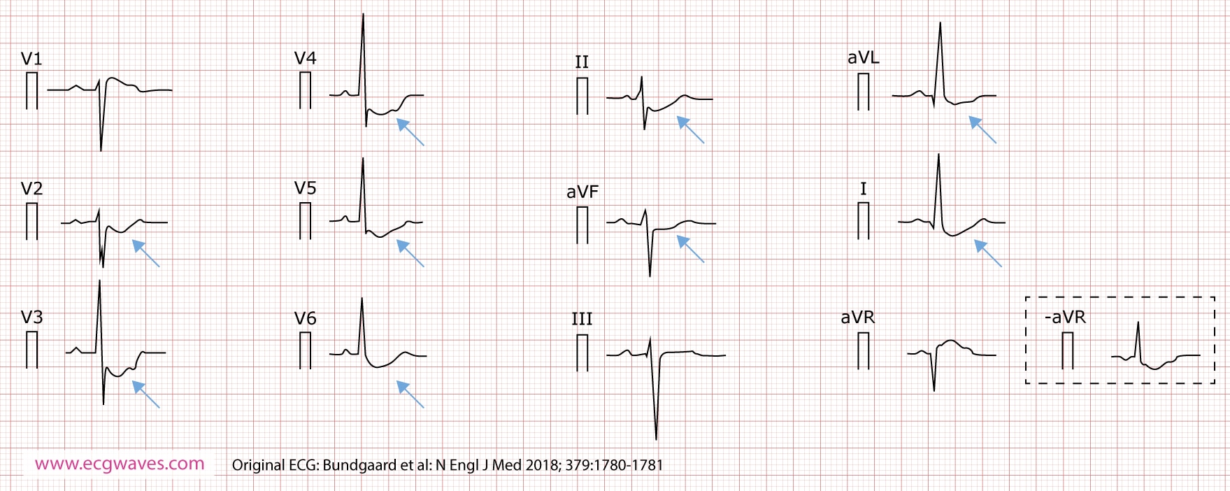 Figur 4. 12-aflednings-EKG (præsenteret i henhold til Cabrera), optaget i en alder af 63 år, viser konkav opadgående ST-segmentdepression i afledning I, II, aVL, aVF og V2 til V6; og ST-segmentforhøjelse i afledning aVR (som svarer til en identisk ST-segmentdepression i den inverterede afledning -aVR). Et hak er tydeligt i den stigende del af ST-segmentet.