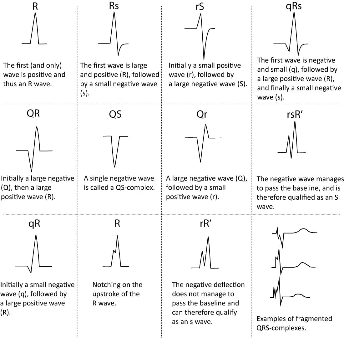 Figur 5. Navngivning af QRS-komplekset.