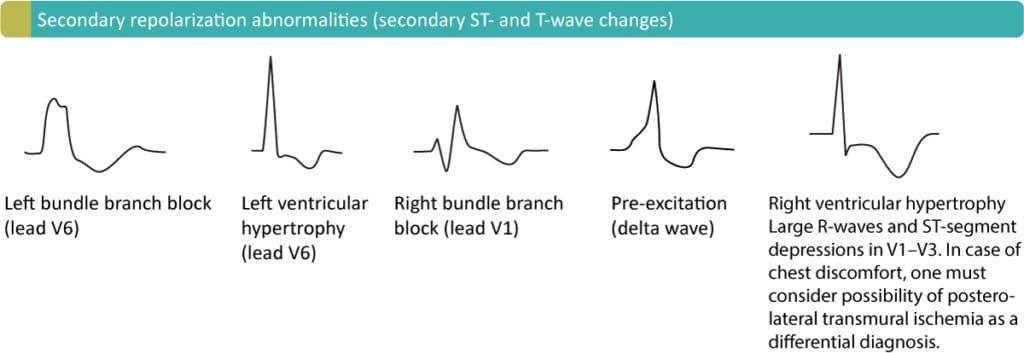 Figur 4. Sekundære ST-T-forandringer på grund af LBBB (venstre grenblok), LVH (venstre ventrikelhypertrofi), RBBB (højre grenblok), præeksitation (WPW-syndrom) og RVH (højre ventrikelhypertrofi).