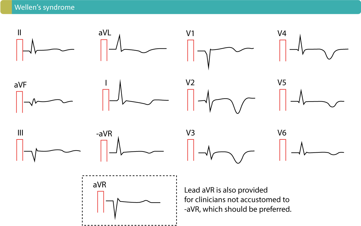 Figur 3. Karakteristiske T-bølge-inversioner forårsaget af Wellen's syndrom. Dette EKG-mønster kaldes almindeligvis Wellen's tegn.