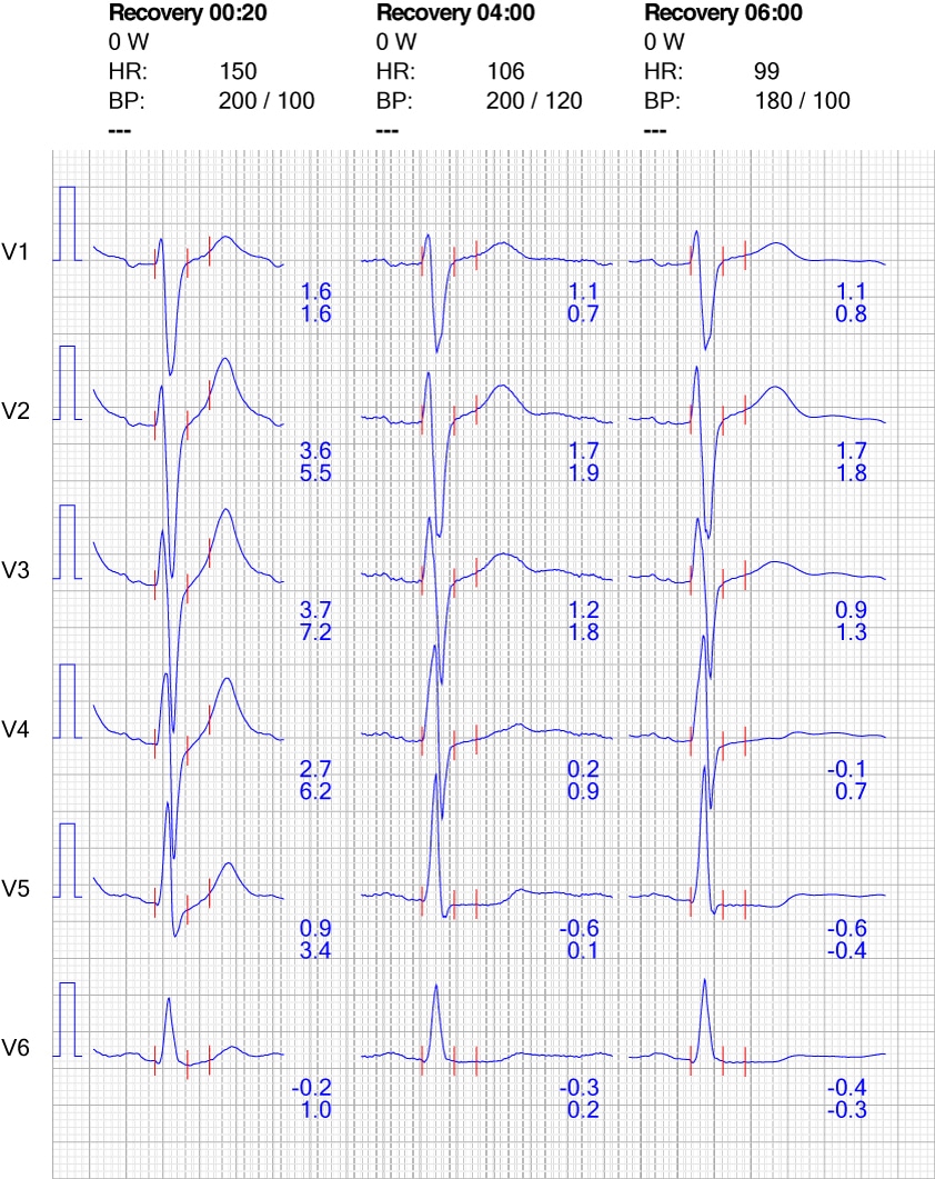 Figur 10. EKG-reaktion i brystafledninger under restitution.