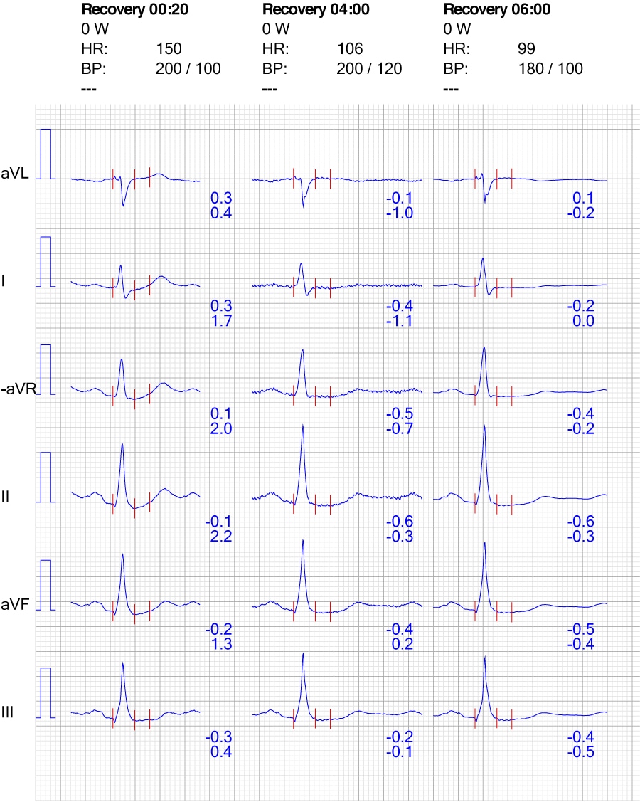 Figur 8. EKG-reaktion i ekstremitetsafledninger under restitution.