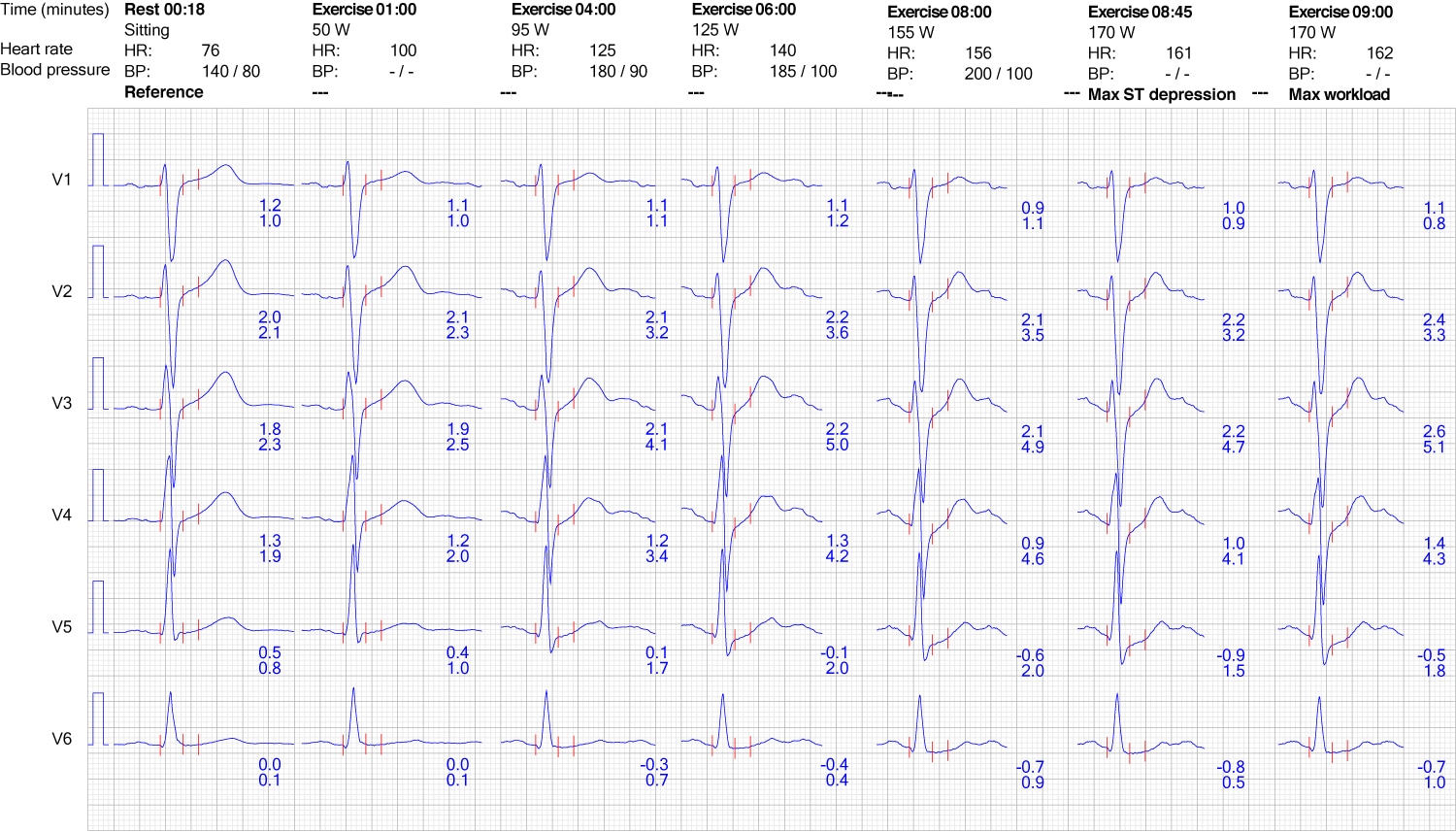 Figur 9. EKG-reaktion i brystafledninger under træning.
