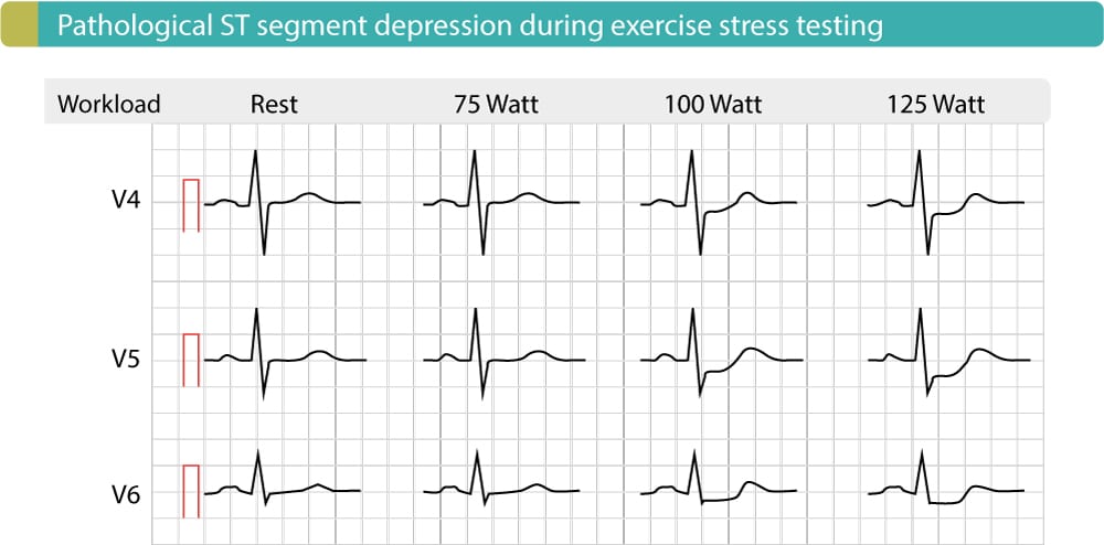 Figur 5. Anstrengelses-EKG hos en patient med koronararteriesygdom viser signifikante ST-sænkninger i J-60-punktet og J-80-punktet. Disse depressioner bliver mere udtalte, når arbejdsbelastningen øges. Denne test blev udført på cykel.