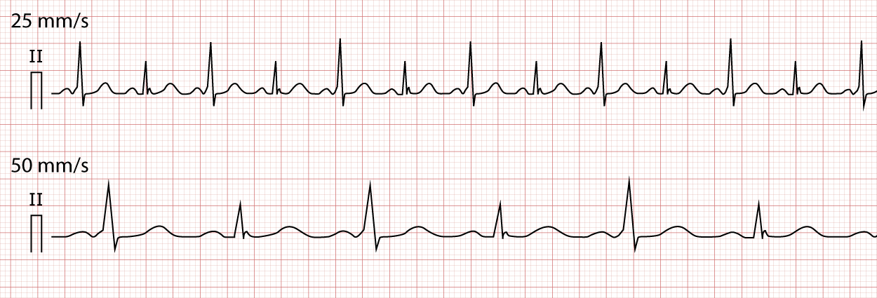 Figur 6. EKG-optagelse, hvor hvert andet slag ledes gennem den accessoriske bane, hvilket resulterer i variationer i QRS-amplituden (elektrisk alternans).