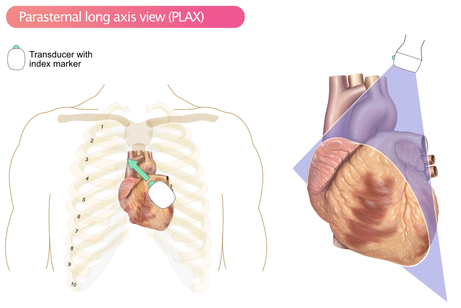 Figur 1. PLAX, parasternal visning af den lange akse.