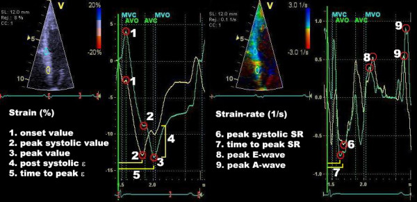 Figur 7. Parametre på strain- og strain rate-diagrammer. Begge paneler viser det samme myokardieområde, dvs. basal septum. Kilde