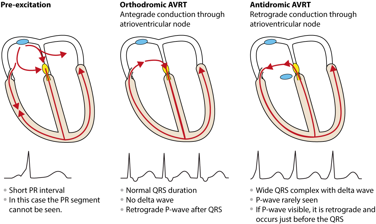 Figur 3. Antidromisk og ortodromisk AVRT.