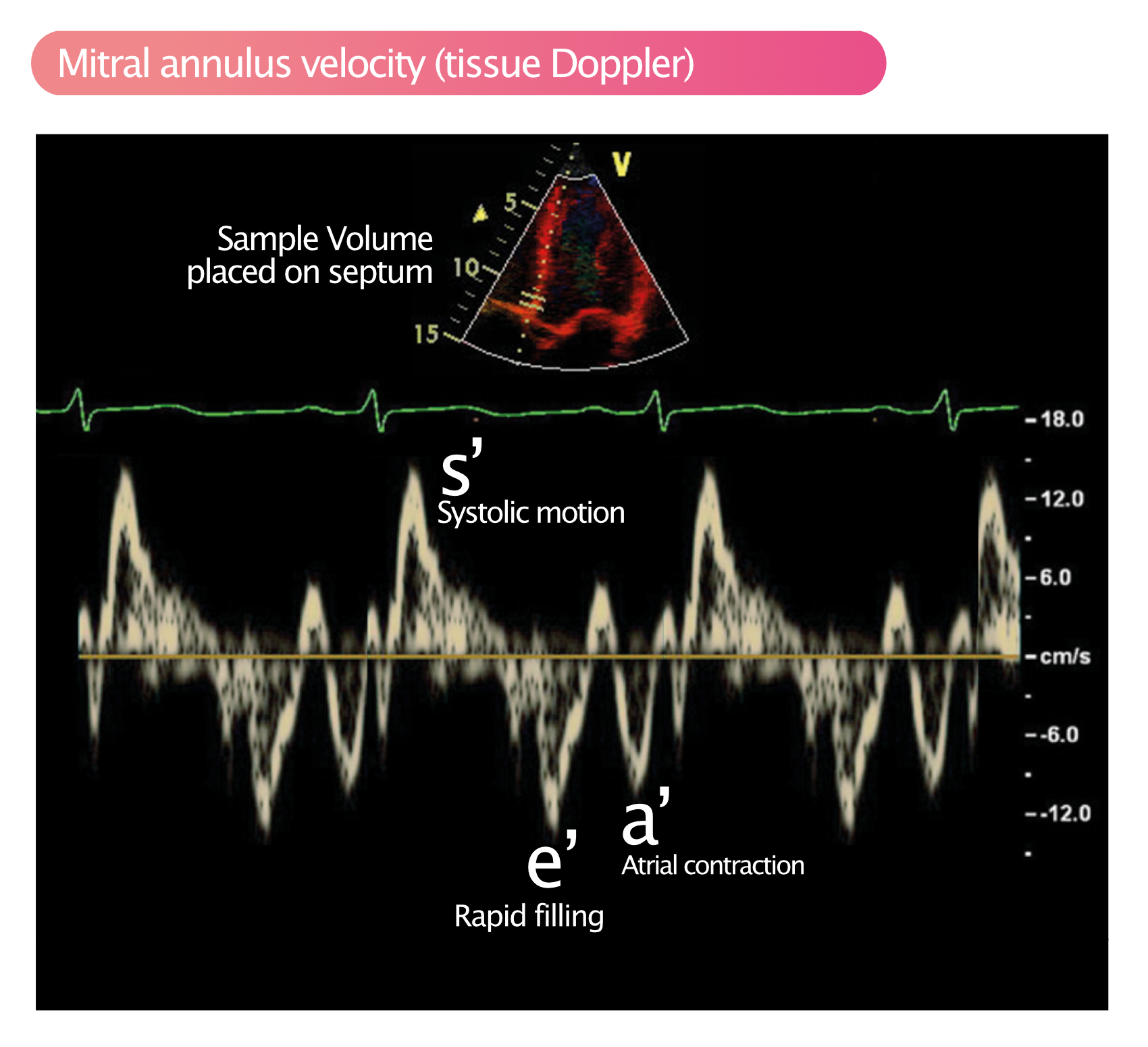 Figur 2. Pulserende vævsdoppler analyserer bevægelser af mitral annulus.