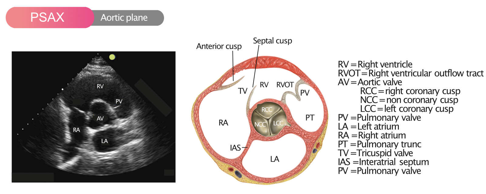Figur 7. Parasternal kortaksevisning (PSAX) i aortaplanet.