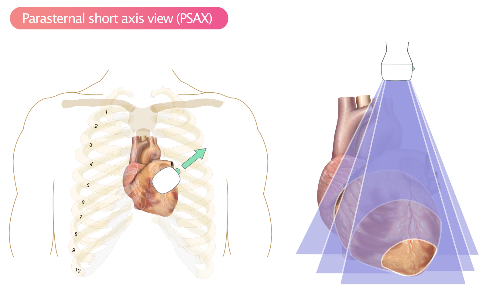 Figur 6. Parasternal kort-akse visning (PSAX).