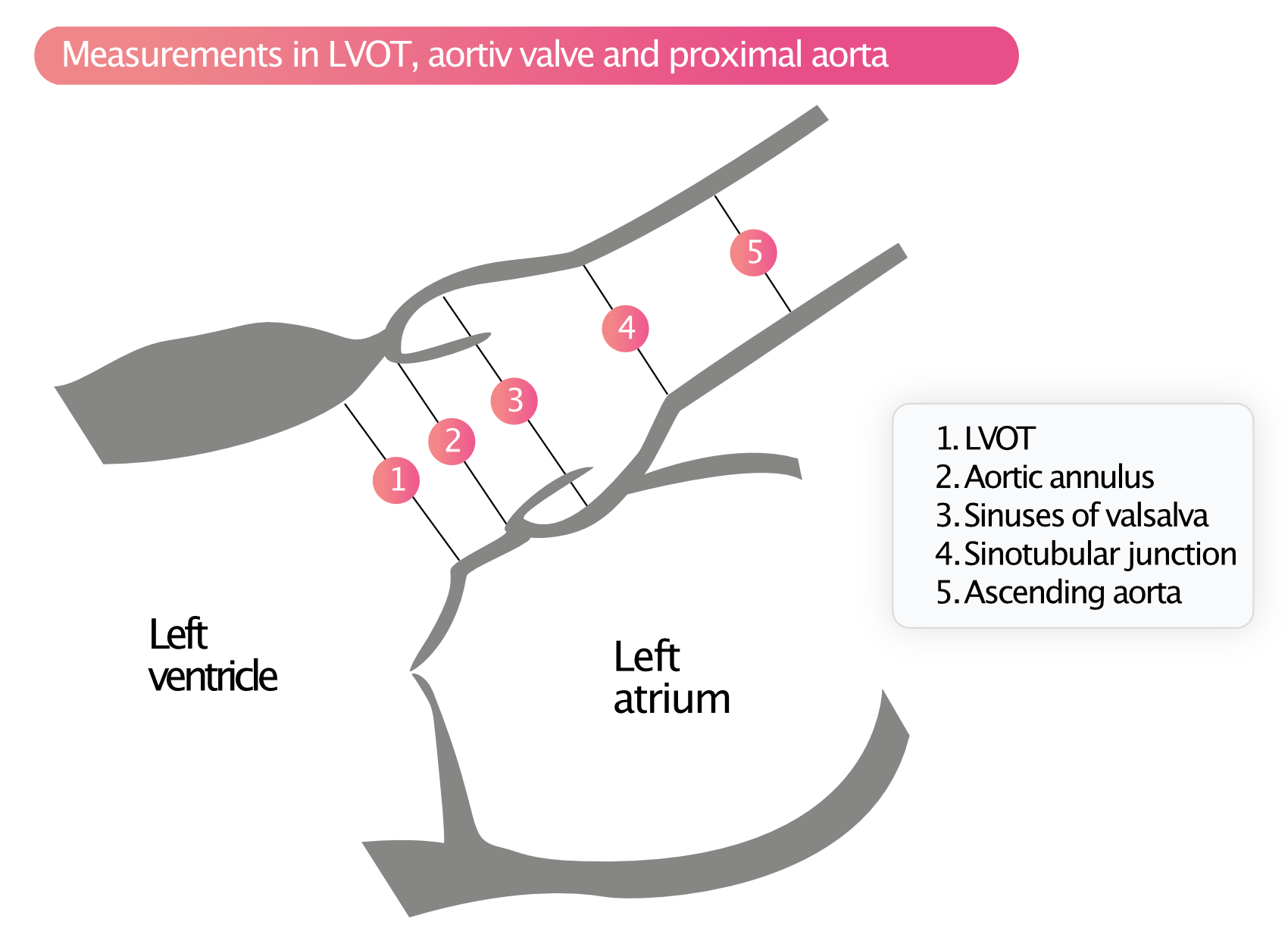 Figur 5. Målinger i LVOT, aortaklappen og den proksimale aorta.