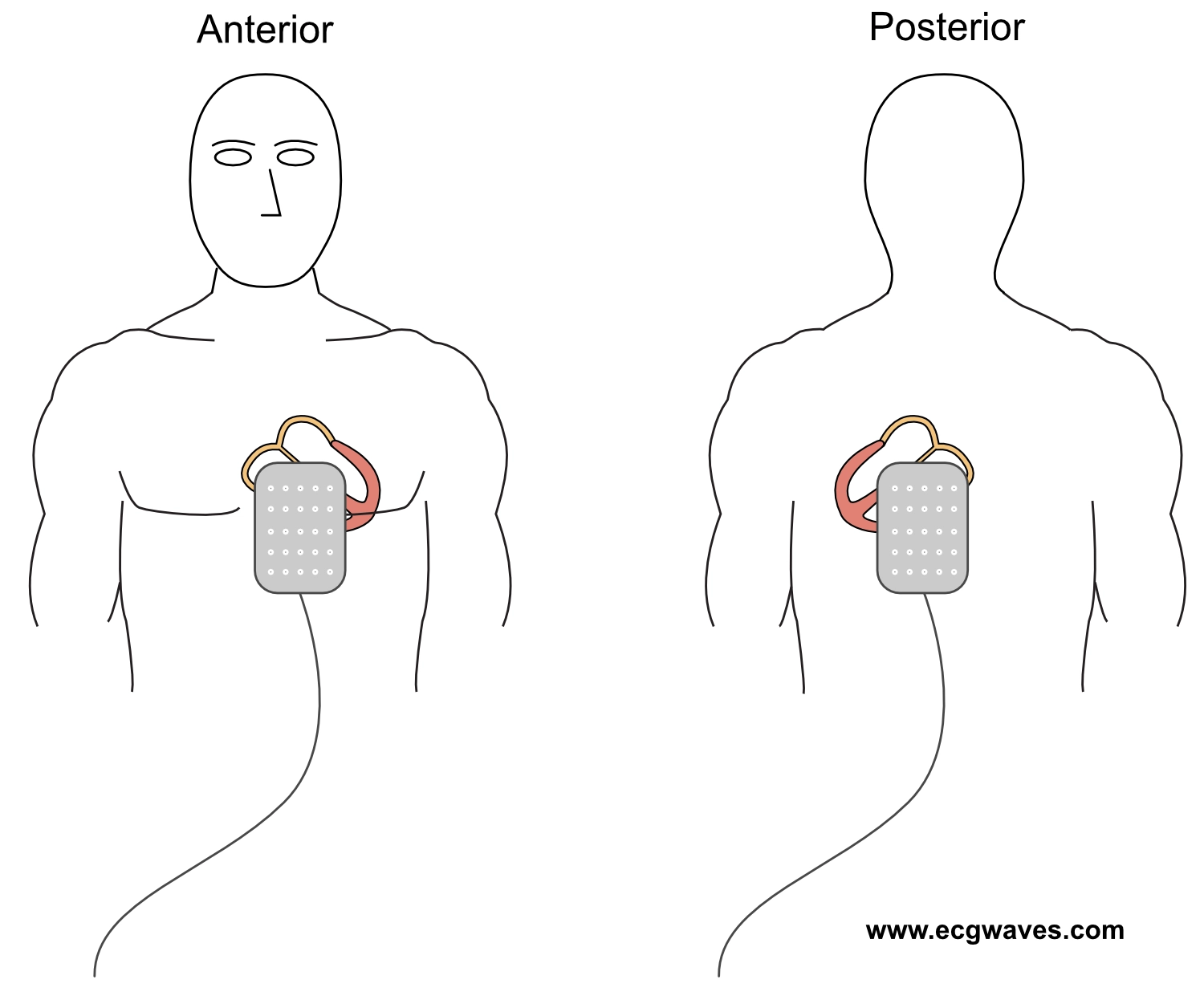 Figur 4. Placering af elektrodepuder i anteroposterior retning til transkutan pacing.