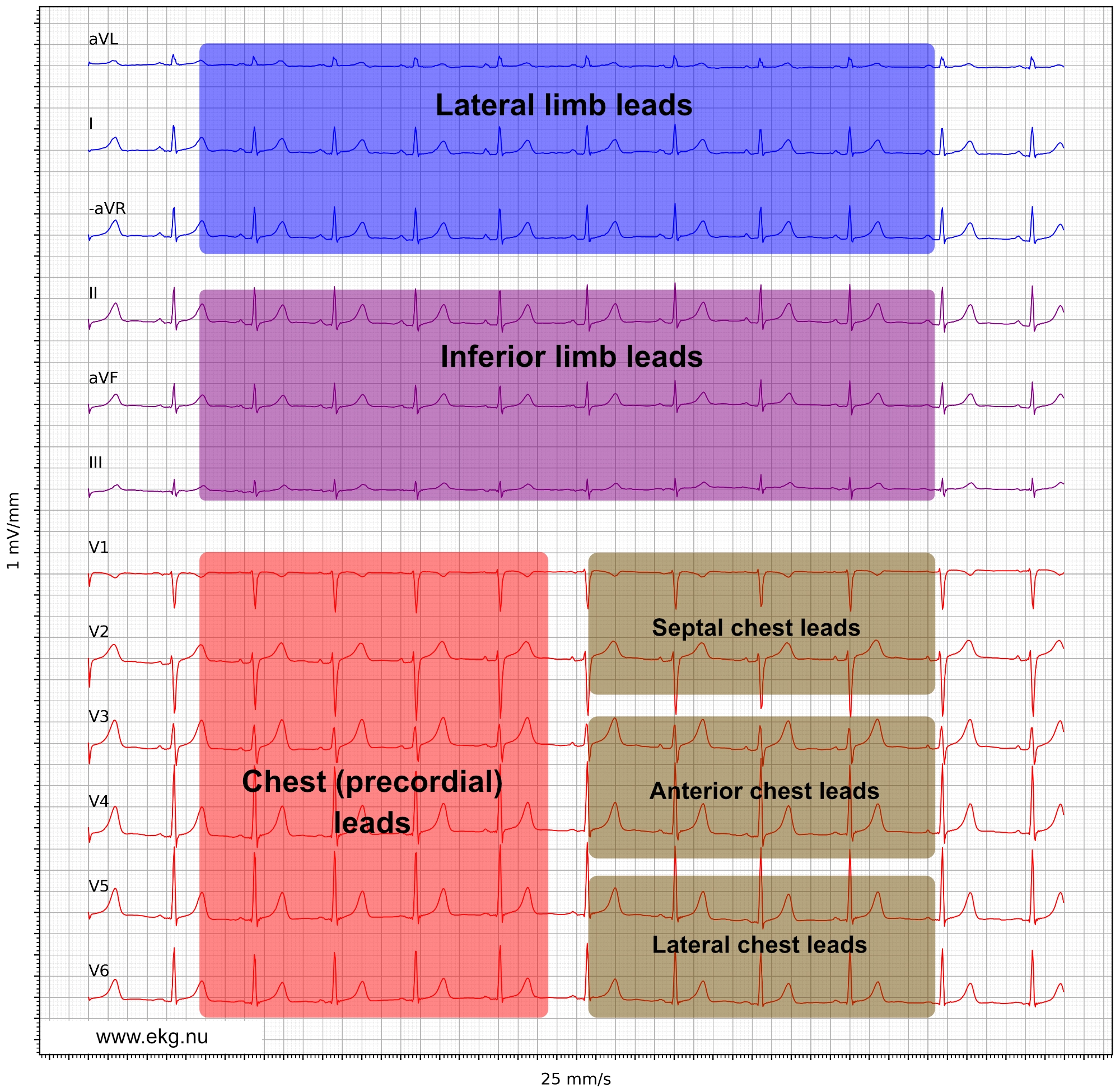 Figur 21. Præsentation af EKG-afledninger i henhold til Cabrera-formatet og aVR inverteret til -aVR.