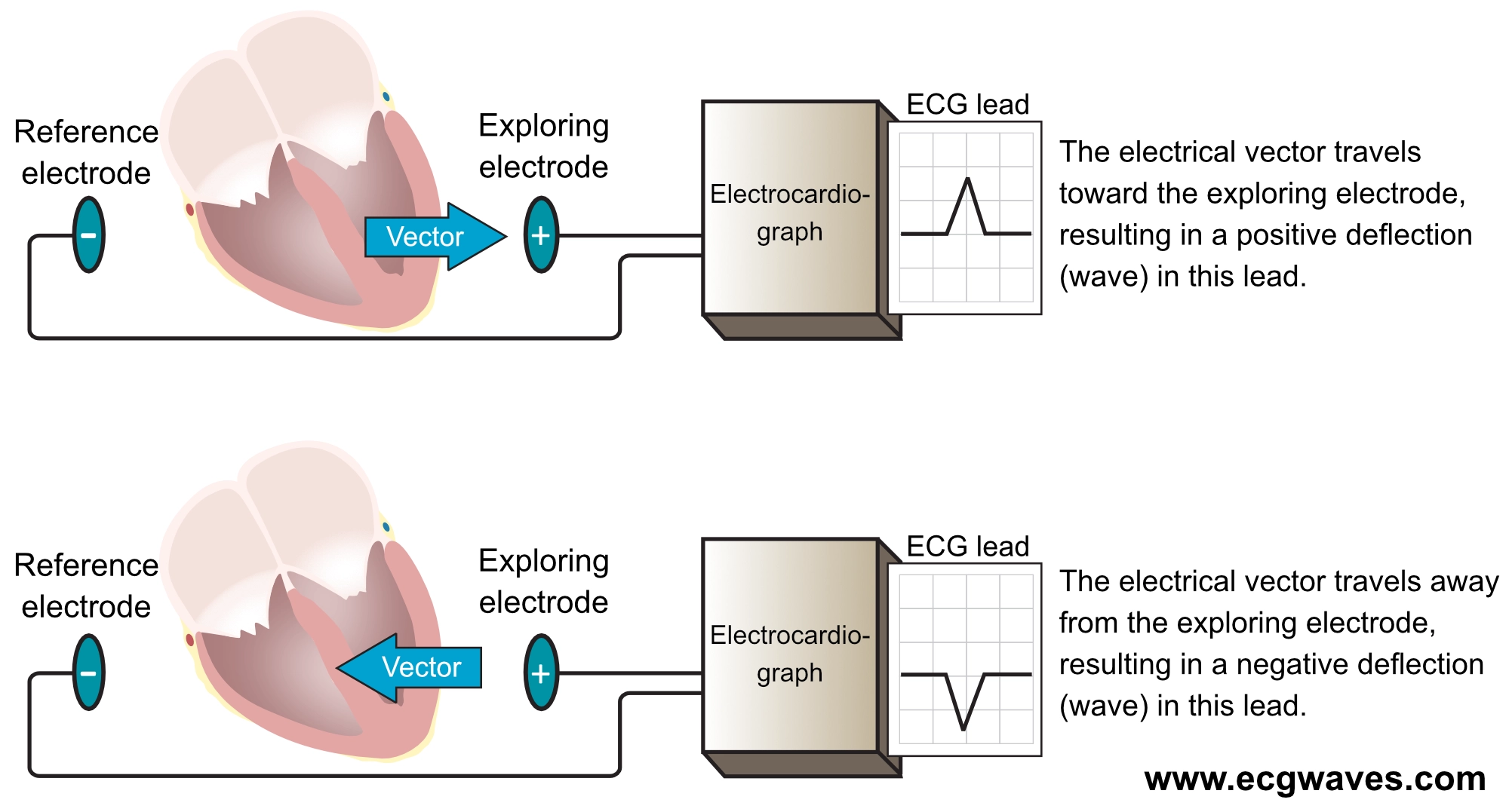 Figur 16. Elektrokardiografen genererer en EKG-afledning ved at sammenligne den elektriske potentialeforskel i to punkter i rummet. I de simpleste afledninger er disse to punkter to elektroder (illustreret i denne figur). Den ene elektrode fungerer som den udforskende elektrode (positiv) og den anden som referenceelektrode. Elektrokardiografen er konstrueret således, at en elektrisk strøm, der bevæger sig mod den undersøgende elektrode, giver en positiv afbøjning og vice versa.