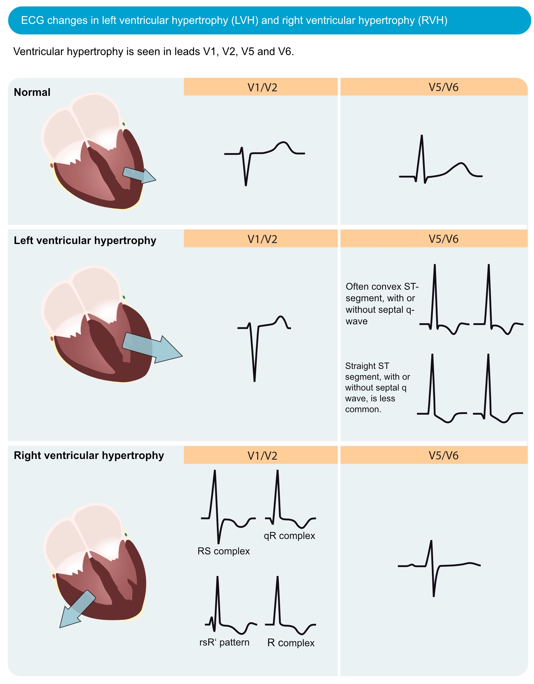 Figur 1. EKG-forandringer ved venstre ventrikelhypertrofi (LVH) og højre ventrikelhypertrofi (RVH). Den elektriske vektor i venstre ventrikel er forstærket ved LVH, hvilket resulterer i store R-bølger i venstresidige afledninger (V5, V6, aVL og I) og dybe S-bølger i højresidige brystafledninger (V1, V2). Højre ventrikelhypertrofi forårsager store R-bølger i højresidede brystafledninger og dybere S-bølger i venstresidede afledninger.