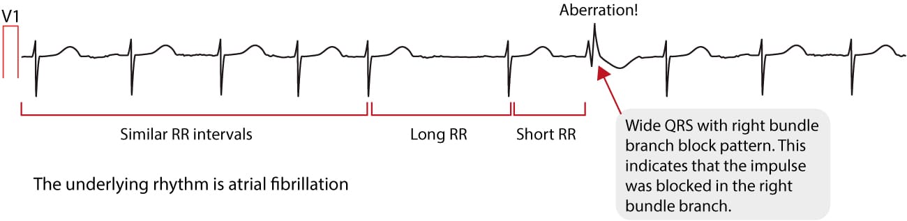 Figur 4. EKG, der viser Ashmans fænomen under atrieflimren.