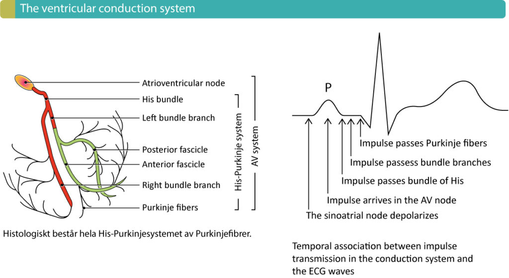 Figure 1. Components of the ventricular conduction system and the temporal association between the ECG waveforms and impulse transmission through the heart. Atrioventricular (AV) blocks occur due to dysfunction in the conduction system.