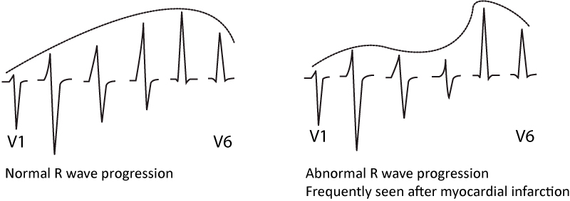 Figure 10. Normal and abnormal R-wave progression.