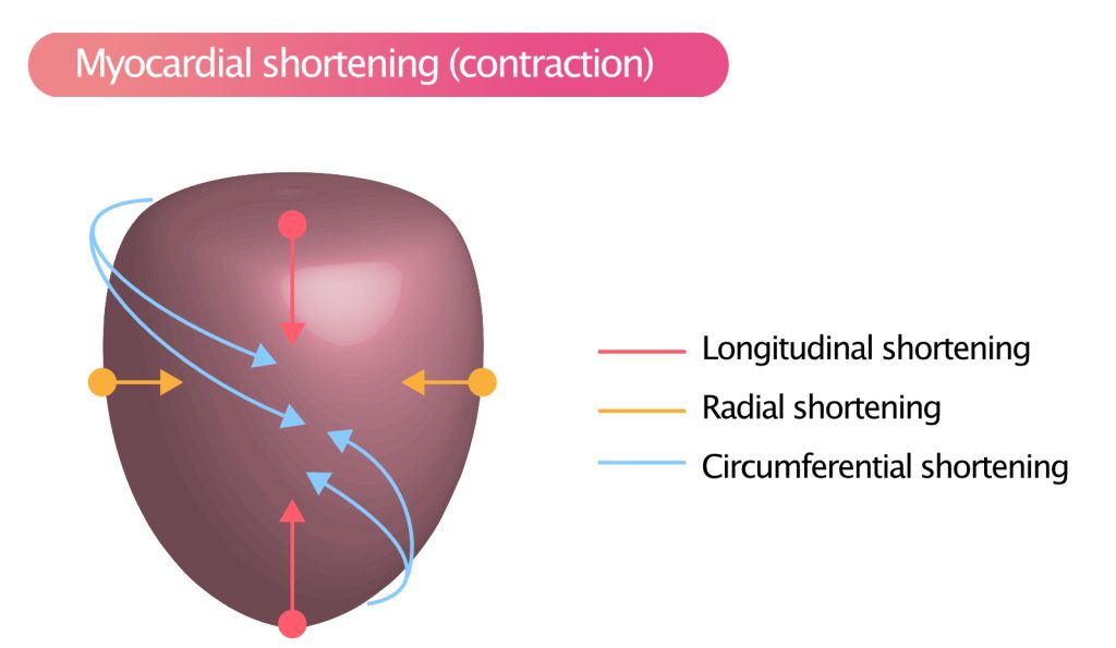 Figure 3. Myocardial contraction (shortening) occurs in three directions: longitudinally, radially and circumferentially.