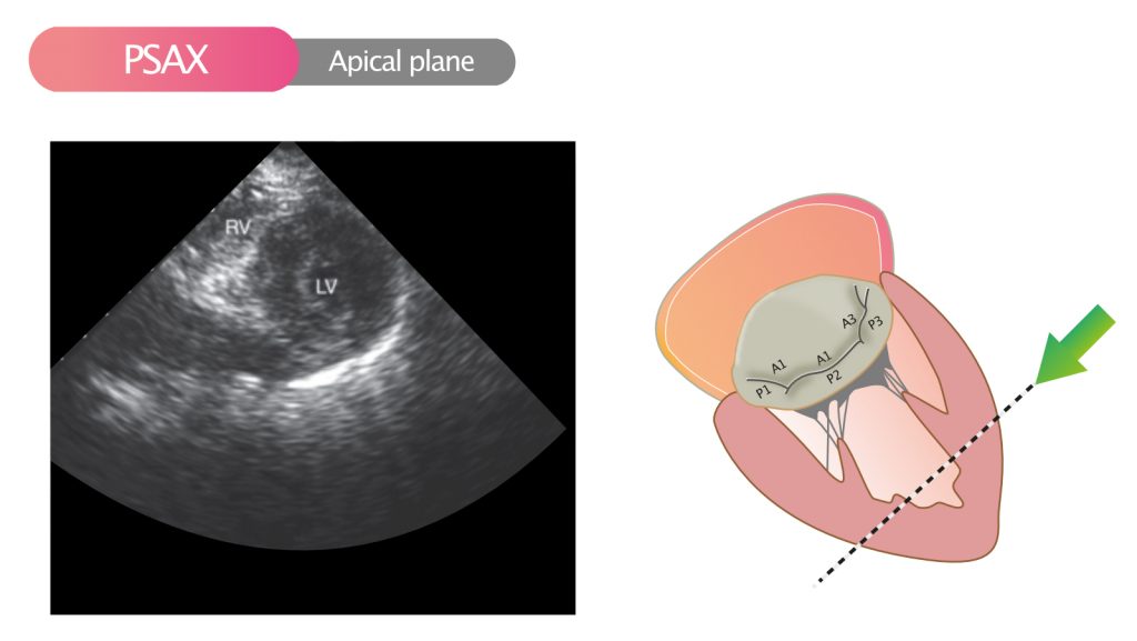 Figure 10. Parasternal short axis view (PSAX) in the apical plane.